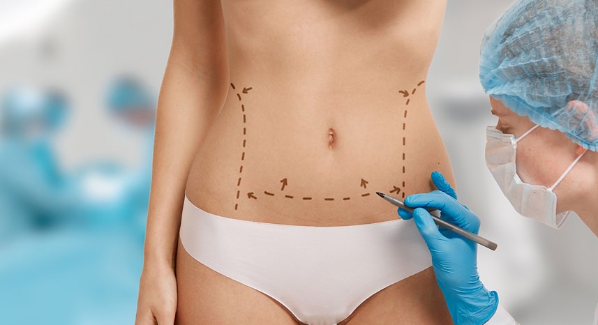 Marcaje prequirúrgico sobre el abdomen antes de un procedimiento corporal