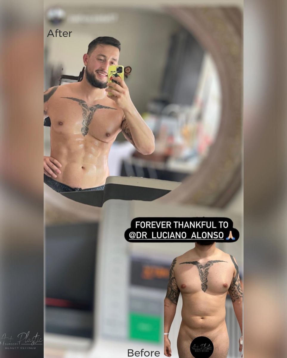 Lipo 360 and abs-max definition, only 6 months post op results!!! 💪🏻😎…