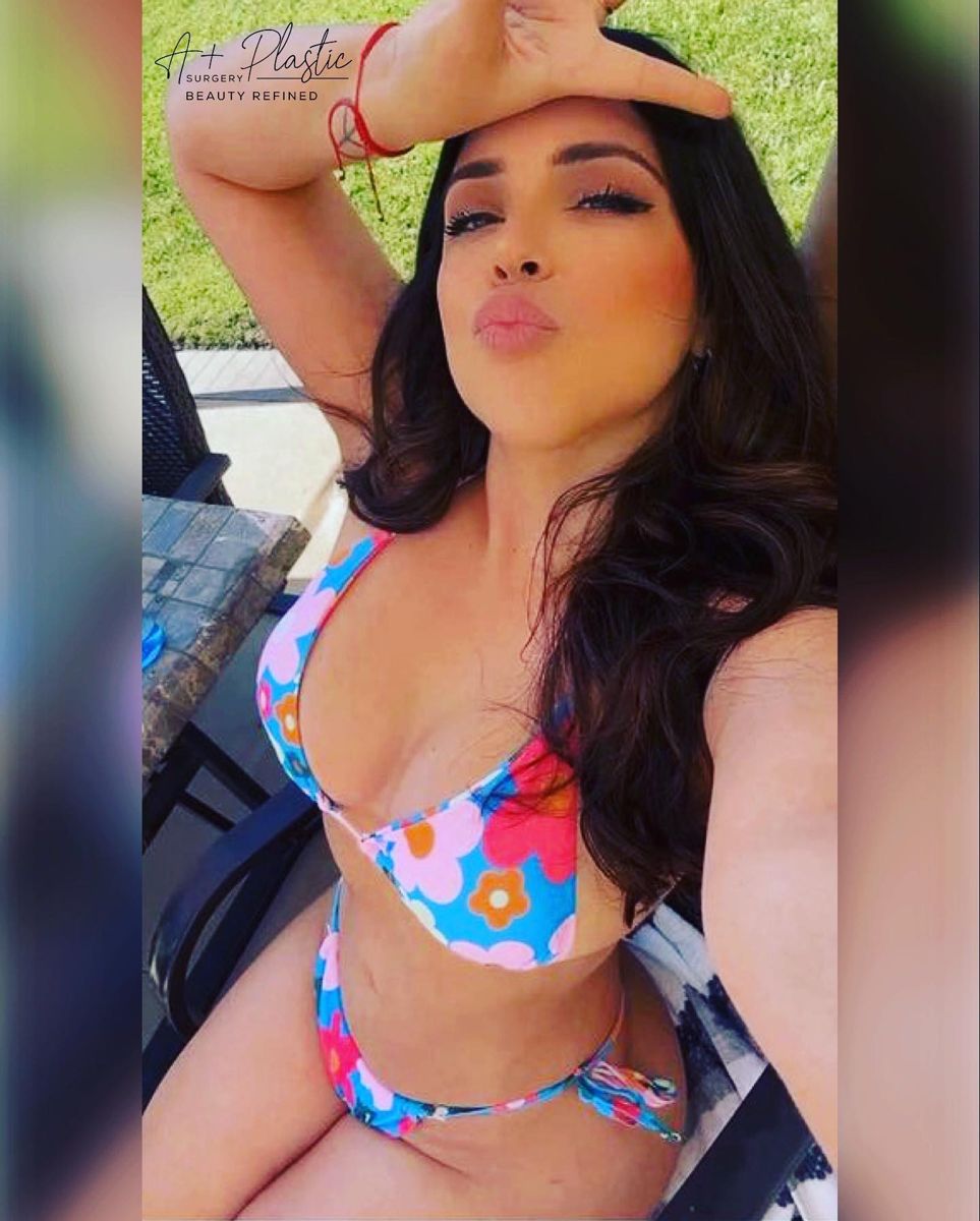 Happy Patient!!! 3 months post op lipo 360 + Bbl + Breast…